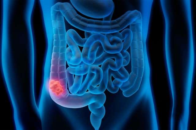 Medical illustration of Colorectal Cancer