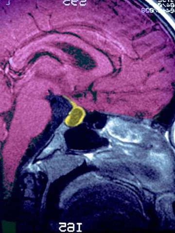 垂体肿瘤扫描